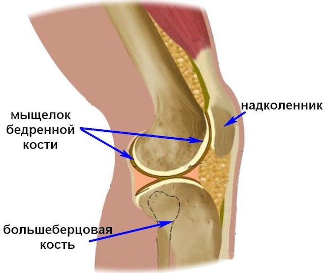 Перелом мыщелка коленного сустава