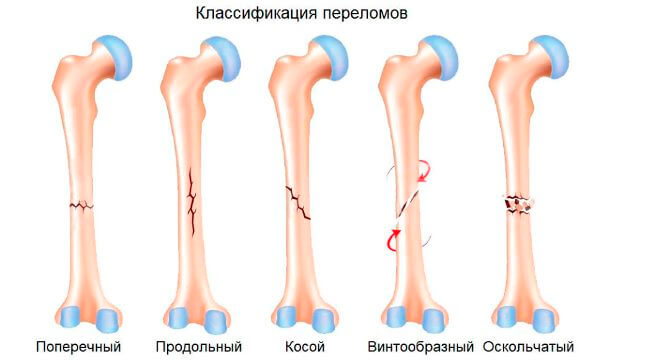 Типы переломов костей
