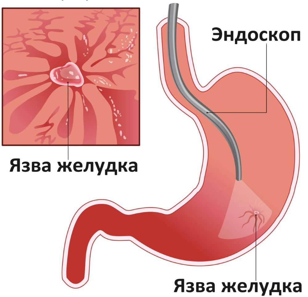 Эндоскопия желудка эндоскопическое исследование желудка