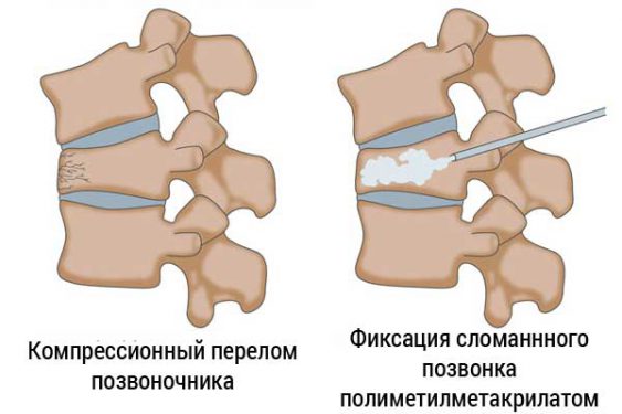 Фиксация перелома грудного отдела позвоночника