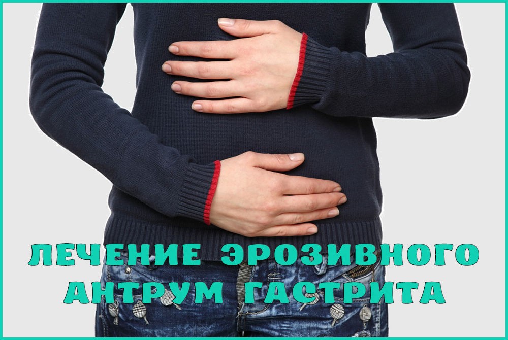 Как лечить эрозивный антрум гастрит Как лечить эрозивный антрум гастрит