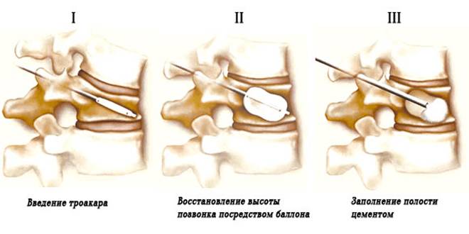 компрессионный перелом позвоночника