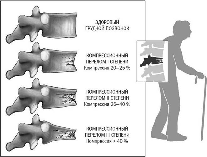 компрессионный перелом позвоночника