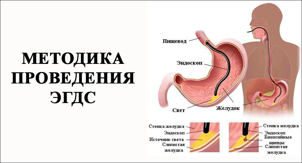 Как выполняется эзофагогастродуоденоскопия Как выполняется эзофагогастродуоденоскопия