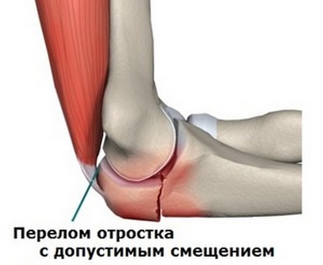 перелом с допустимым смещением