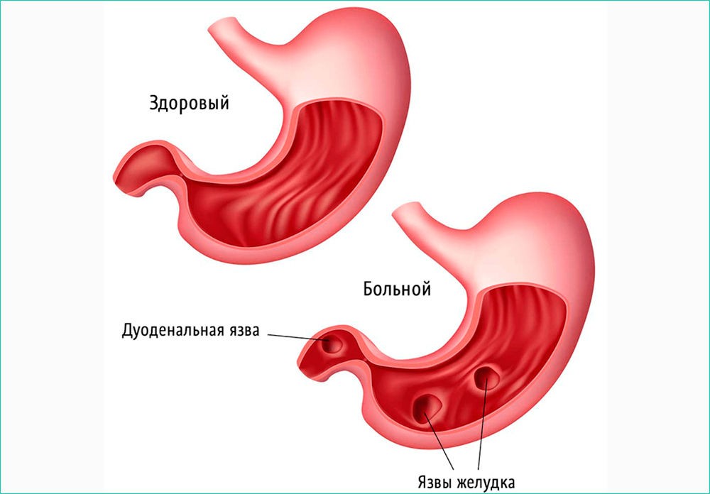 Развитие заболевания Развитие заболевания