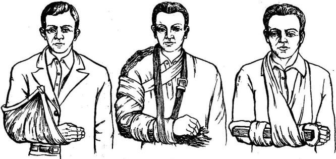 perelom-predplechya (pomosch)