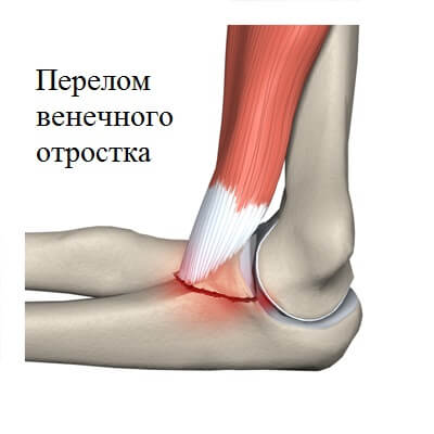 Перелом венечного отростка локтевой кости