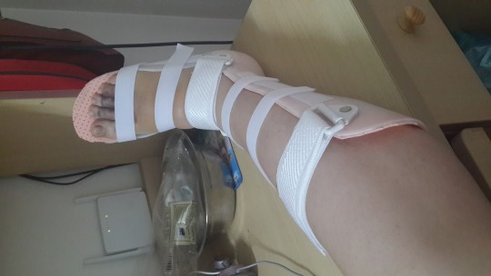 plyusnevaya-kost-prelom (gips)