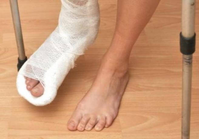 plyusnevaya-kost-prelom-skolko_hodit-gips