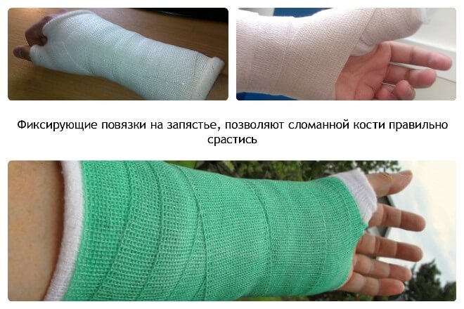 полимерный бинт при переломах луча