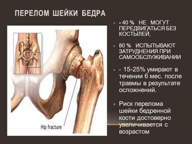 posledstviya_pereloma_bedra