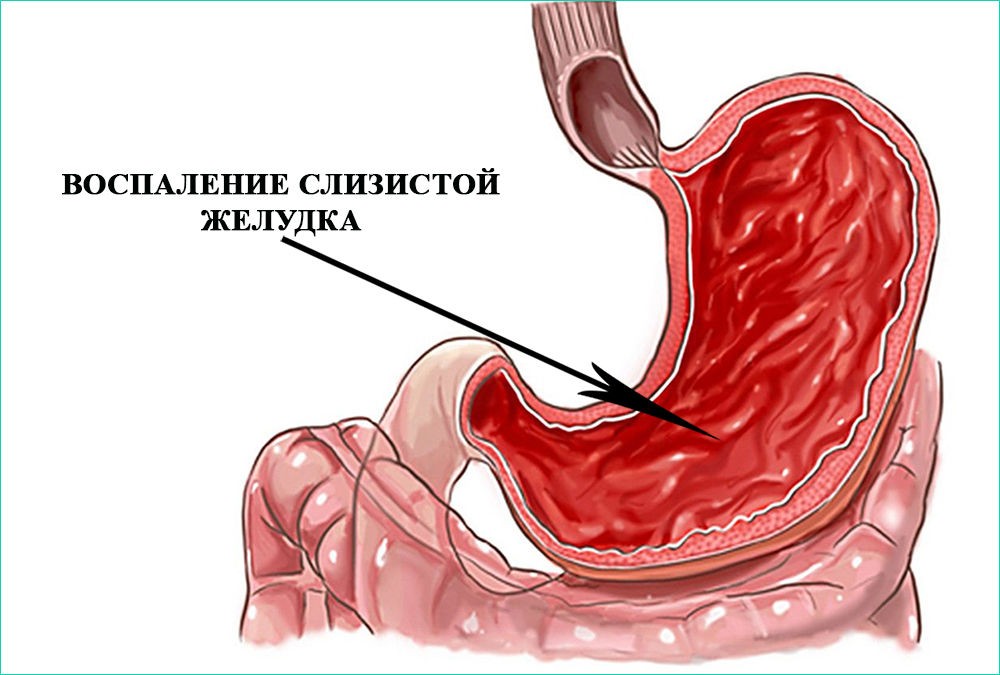 Воспаление слизистой Воспаление слизистой