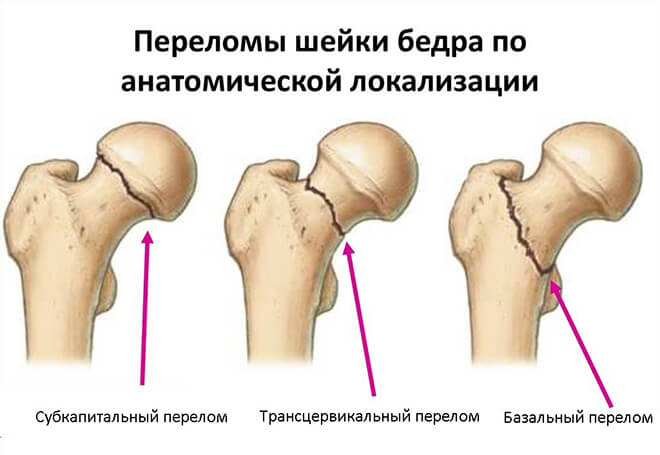 шейка бедра