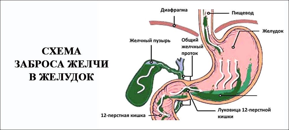 Схема заброса желчи Схема заброса желчи