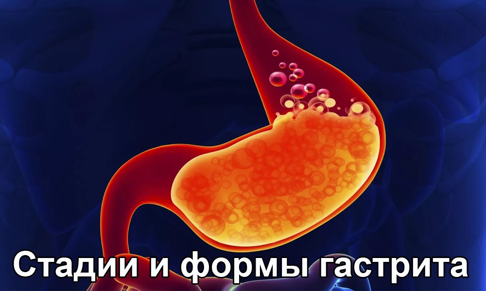 Стадии и формы гастрита Стадии и формы гастрита