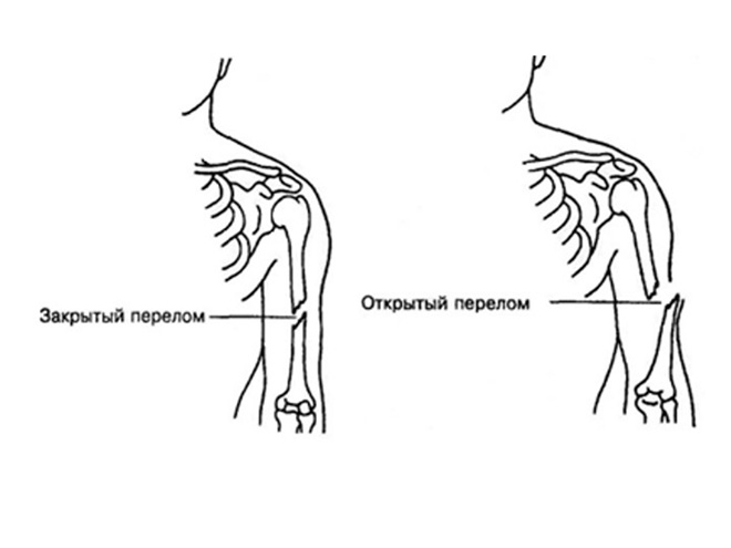 открытый и закрытый перелом