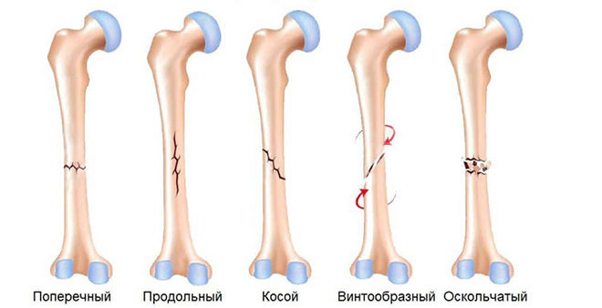 Форма переломоы