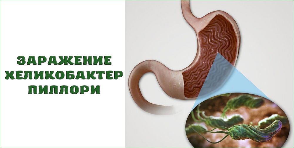 Заражение Хеликобактер пиллори Заражение Хеликобактер пиллори