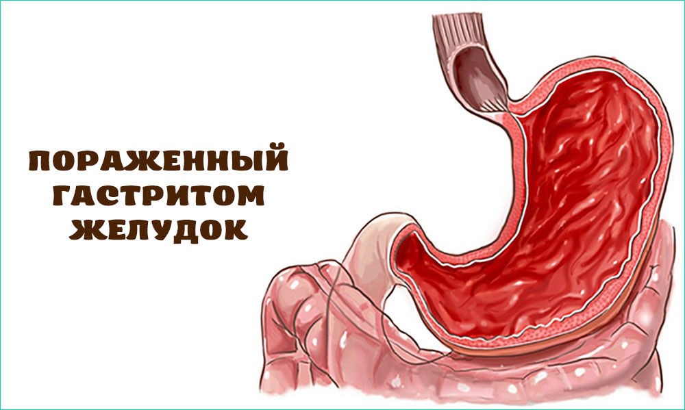 Пораженный гастритом желудок Пораженный гастритом желудок